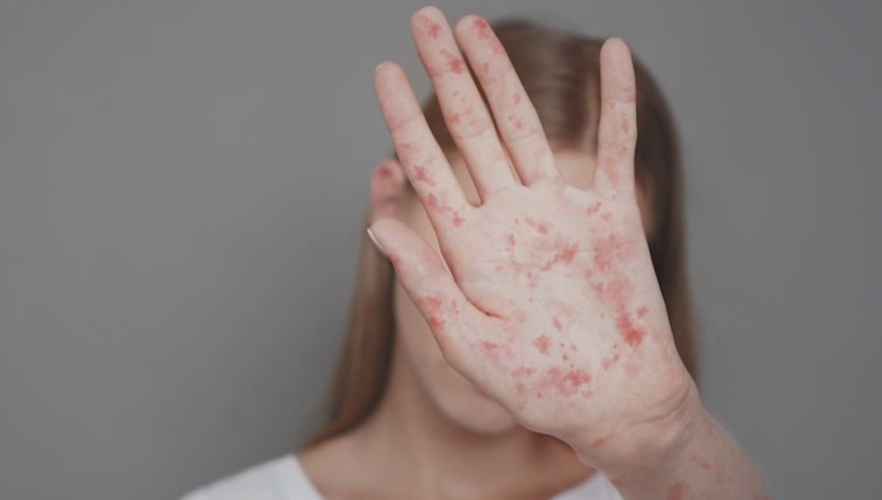 /local/experto-del-hospital-clinico-de-la-universidad-de-antofagasta-alerta-por